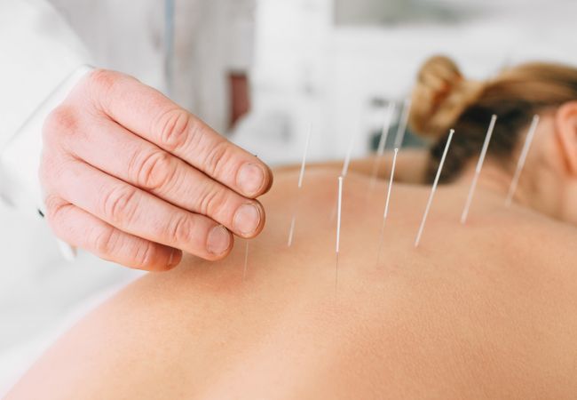 Can You Just Go to One Acupuncture Session for Treatment?