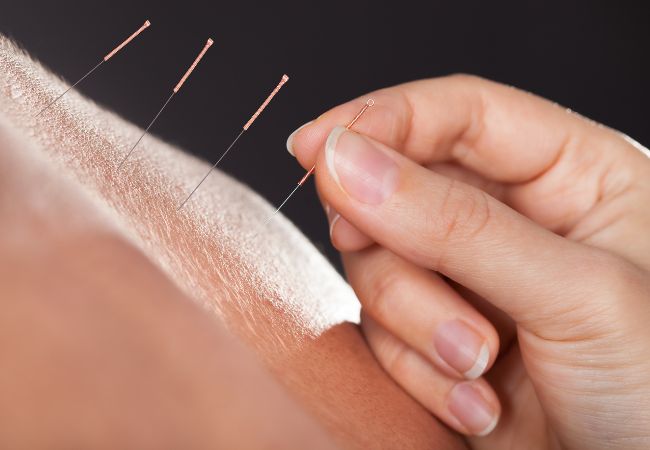 Can You Just Go to One Acupuncture Session for Treatment?