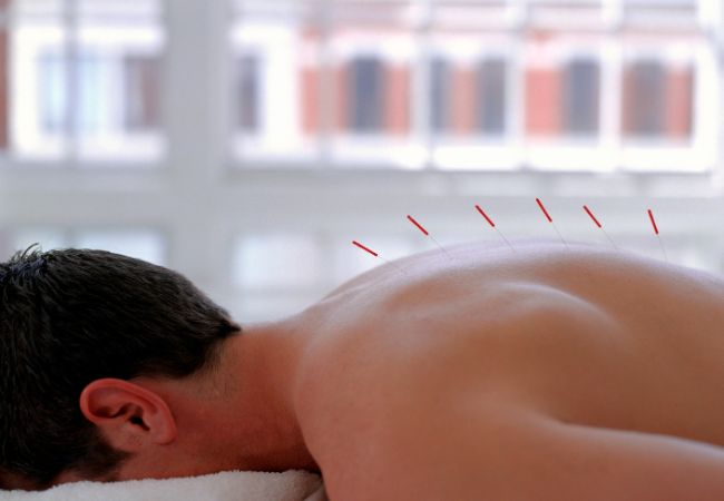 How to Prepare for an Acupuncture Treatment Session